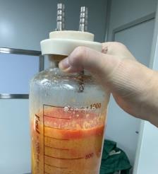 谷城水动力吸脂手术要做多久？